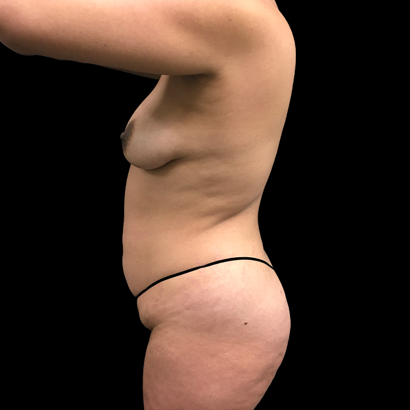 Breast Augmentation With Lift 05