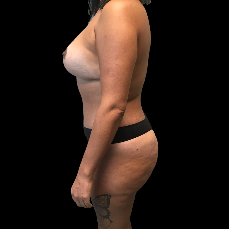 Breast Augmentation With Lift 05