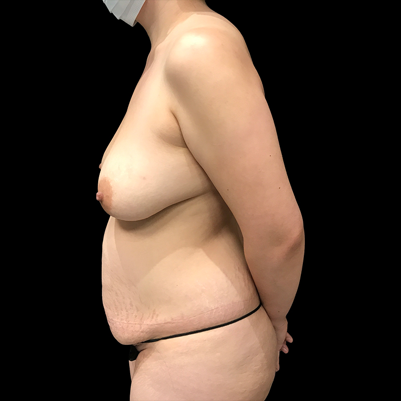 Breast Augmentation With Lift 03