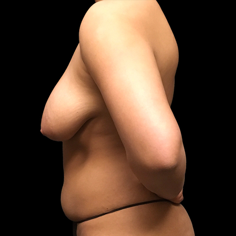 Breast Augmentation With Lift 05