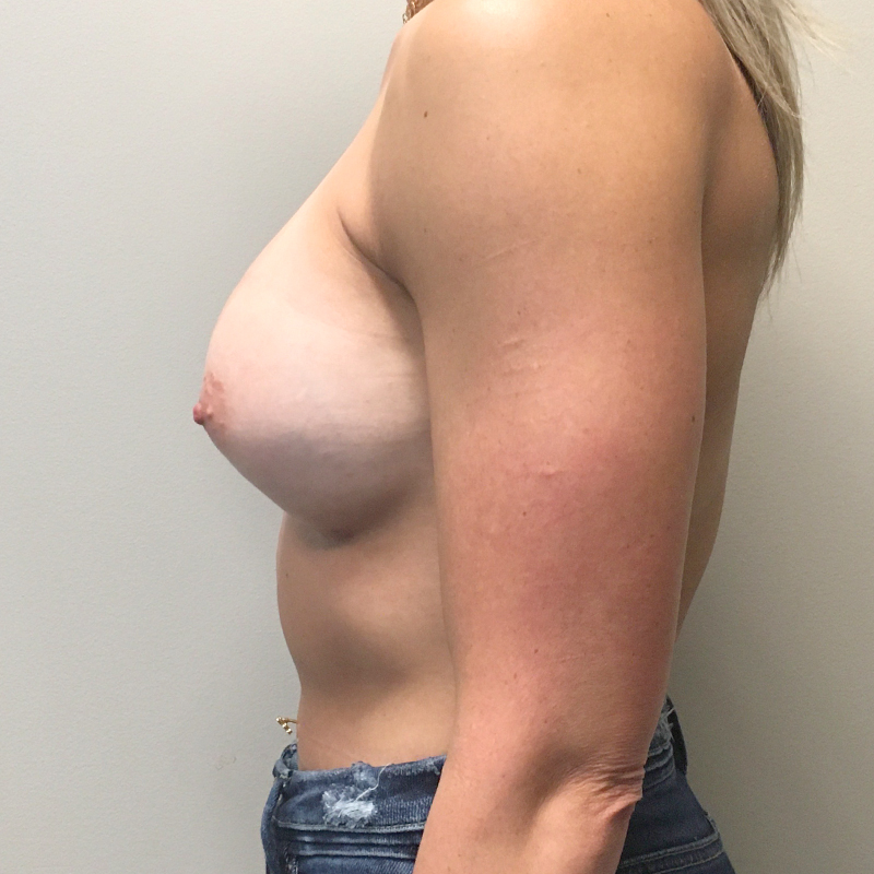 Breast Augmentation 03
