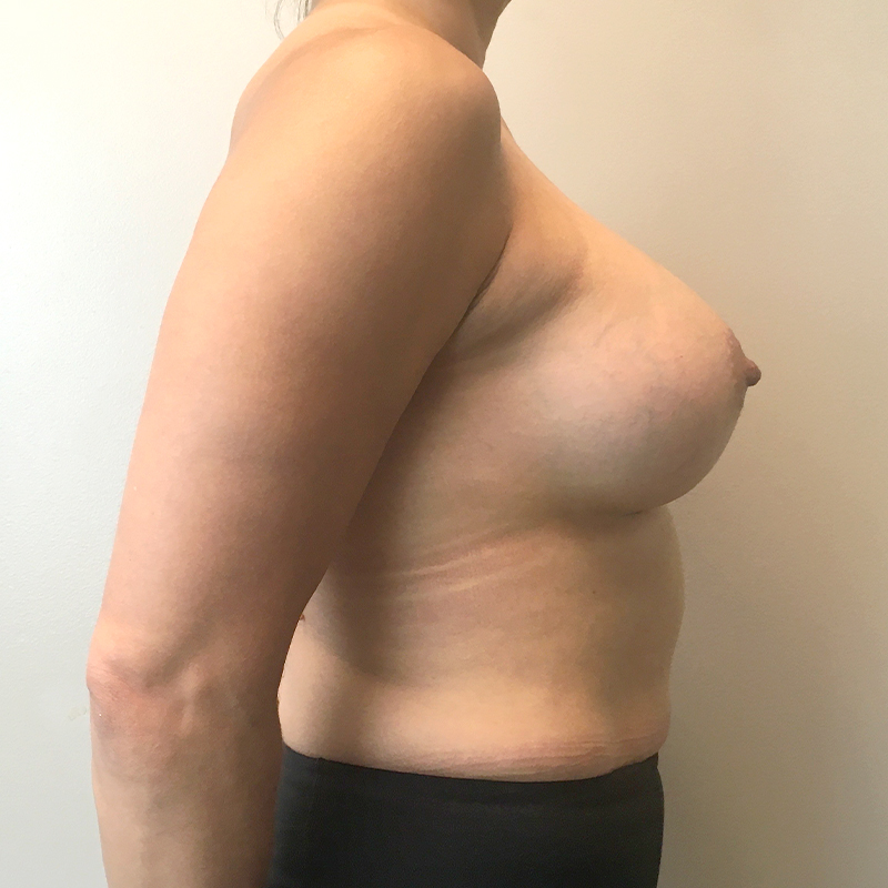 Breast Augmentation 05