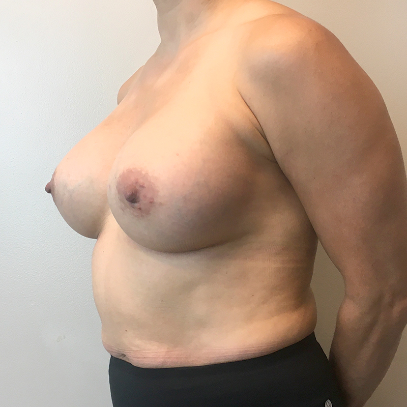 Breast Augmentation 07