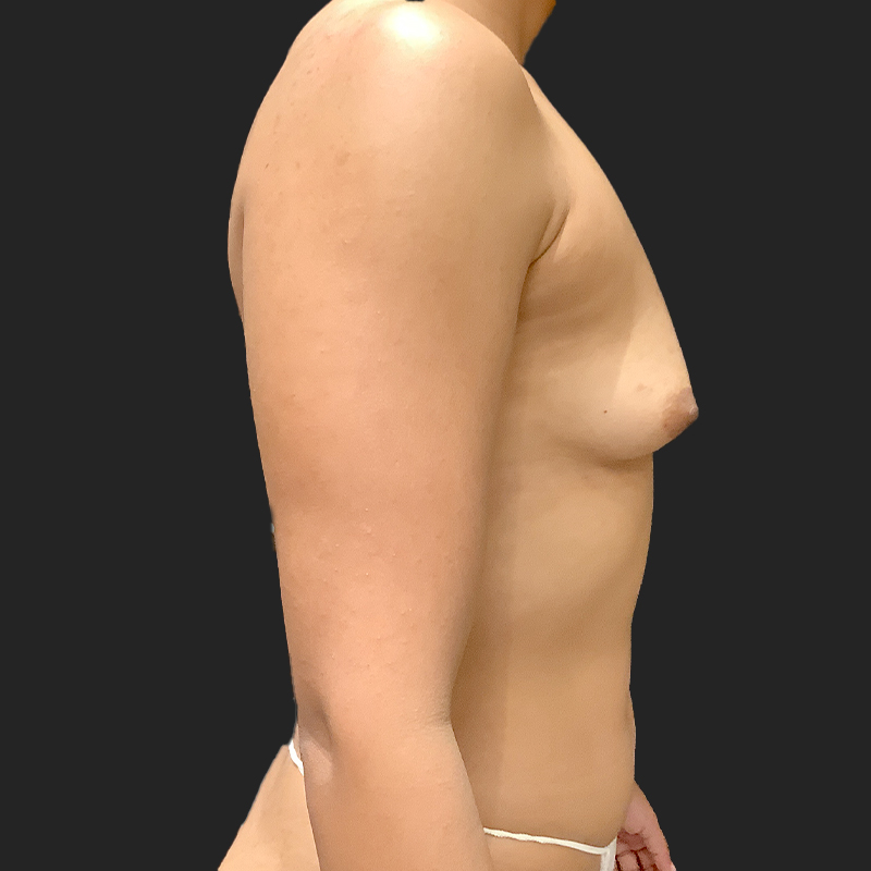 Breast Augmentation 03