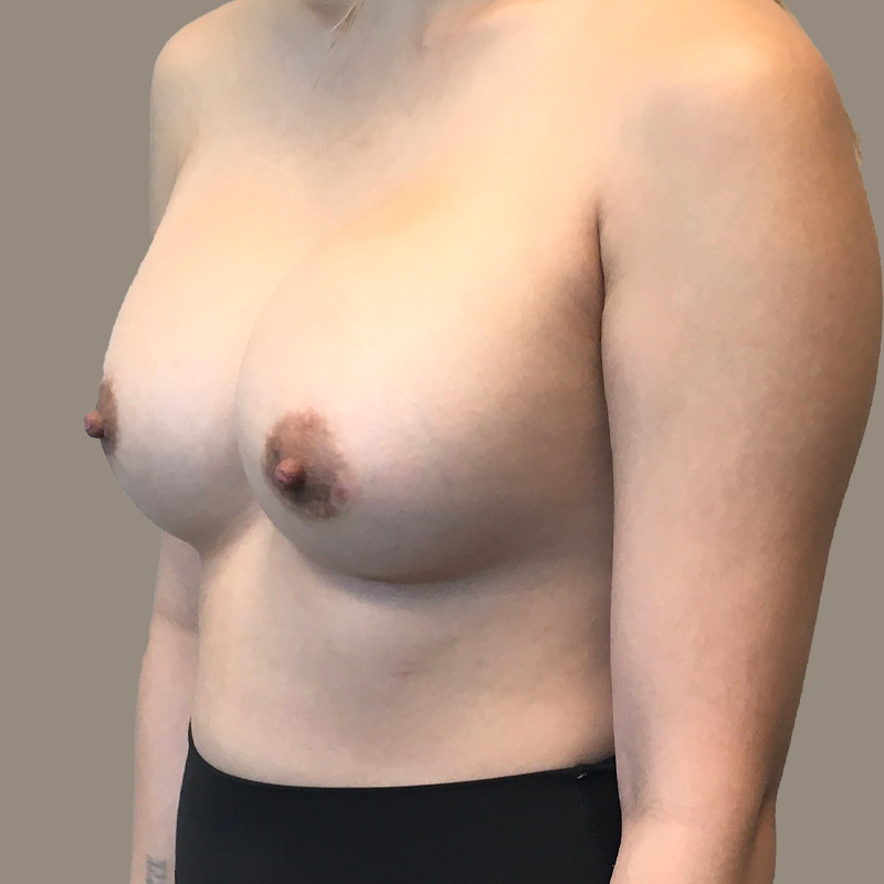 Breast Augmentation 03