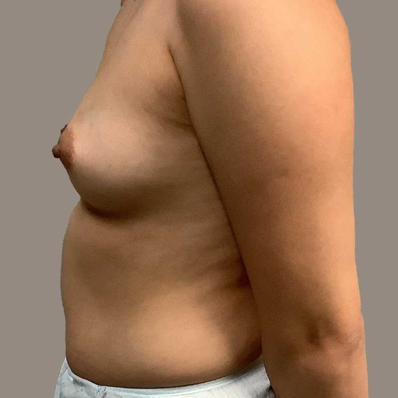 Breast Augmentation 07