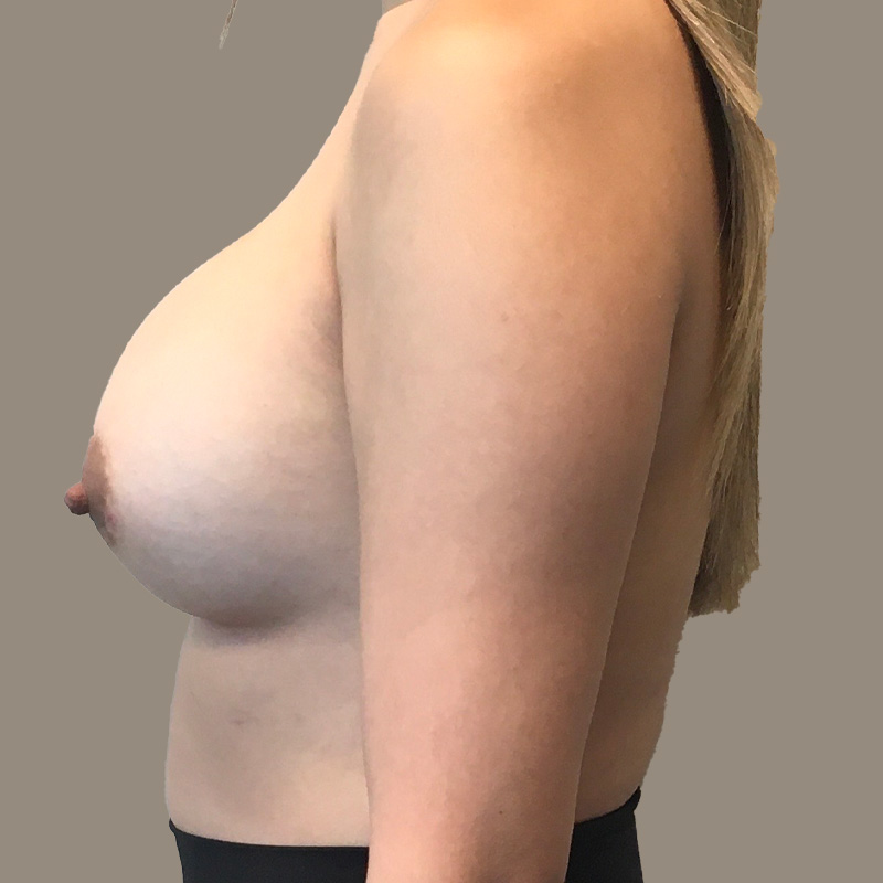 Breast Augmentation 07