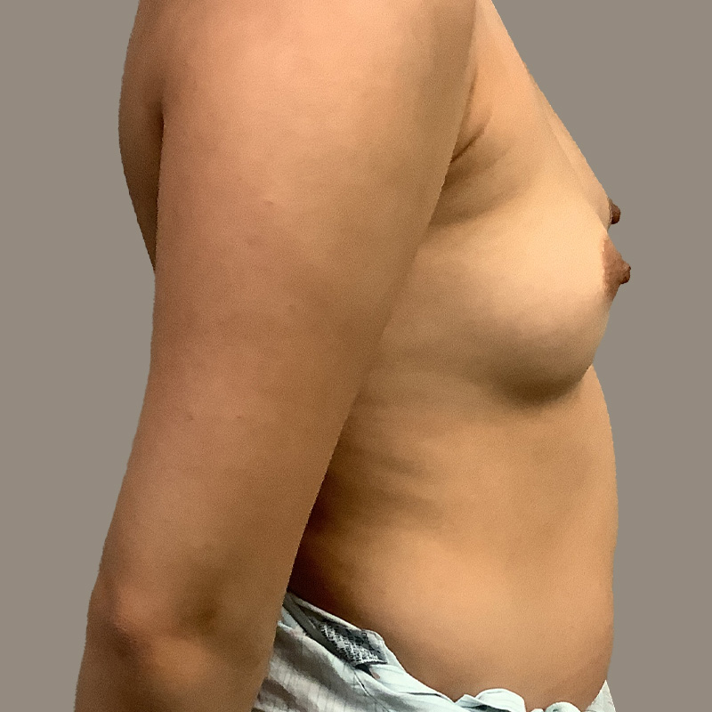 Breast Augmentation 09
