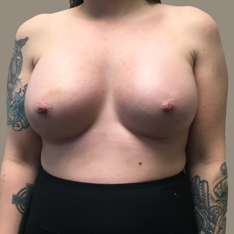 Breast Augmentation 08