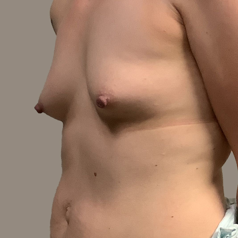 Breast Augmentation 03