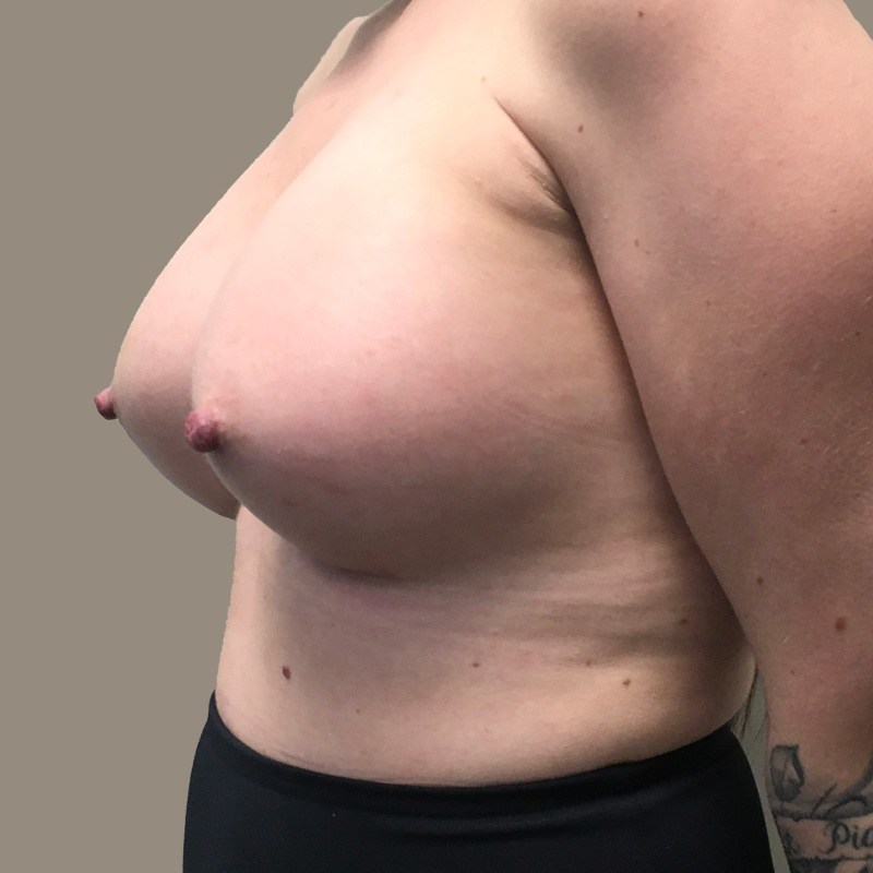 Breast Augmentation 03