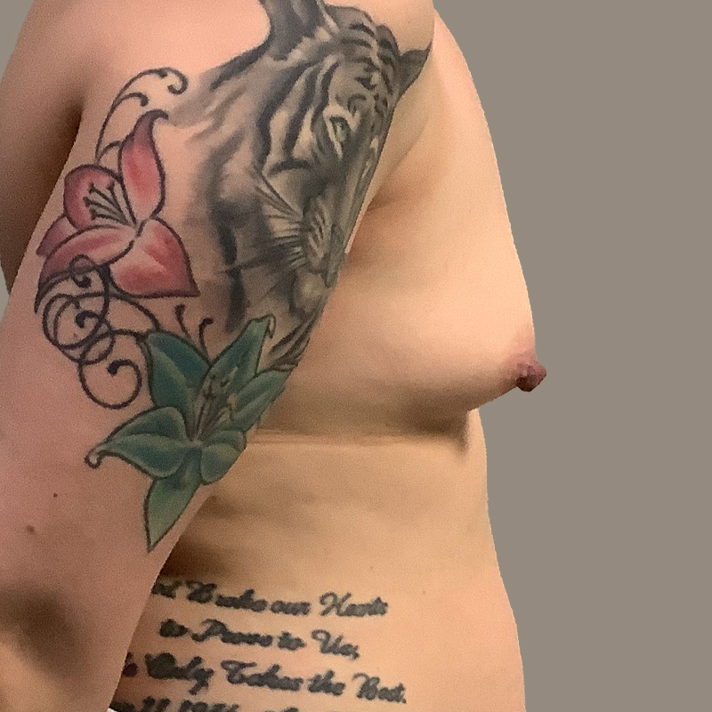 Breast Augmentation 07