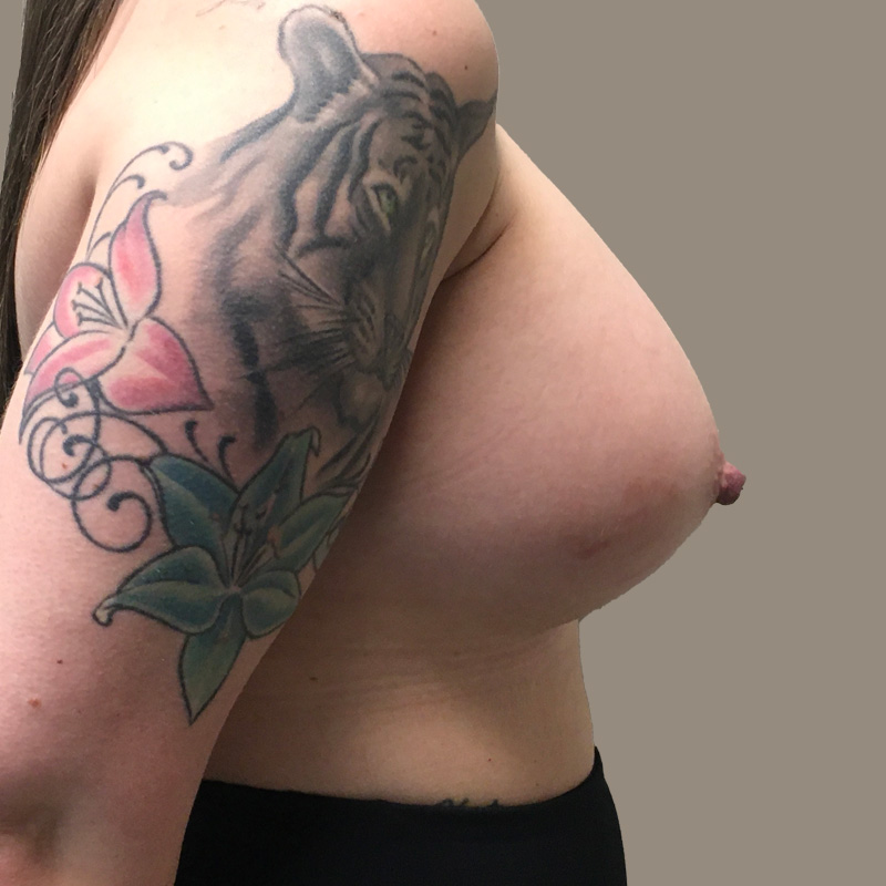 Breast Augmentation 07
