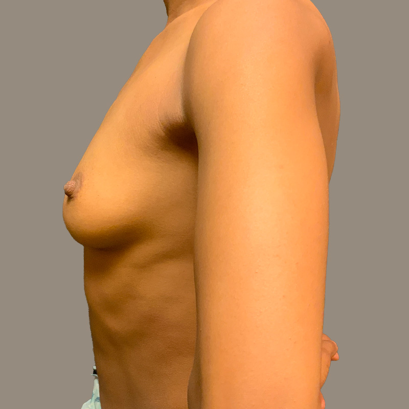 Breast Augmentation 05