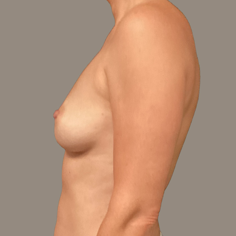 Breast Augmentation 05