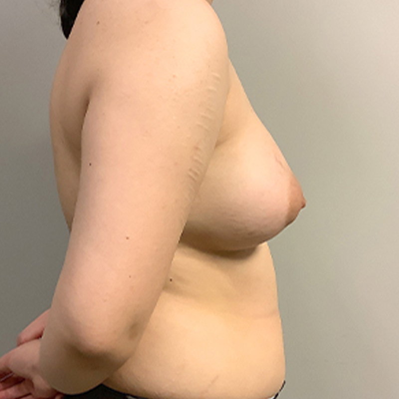 Breast Augmentation 09