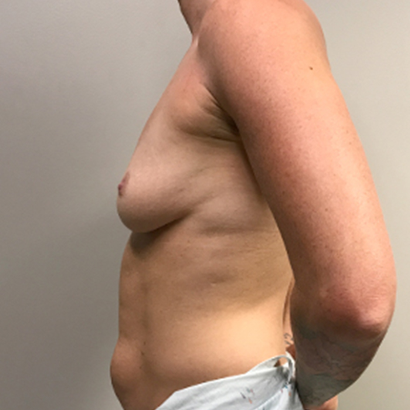 Breast Augmentation 05