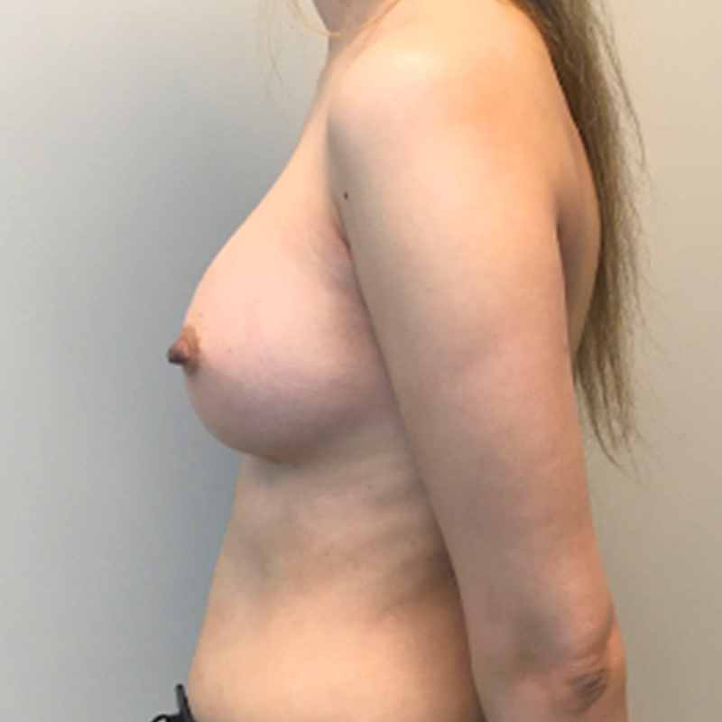 Breast Augmentation 05