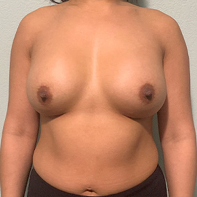 Breast Augmentation 104