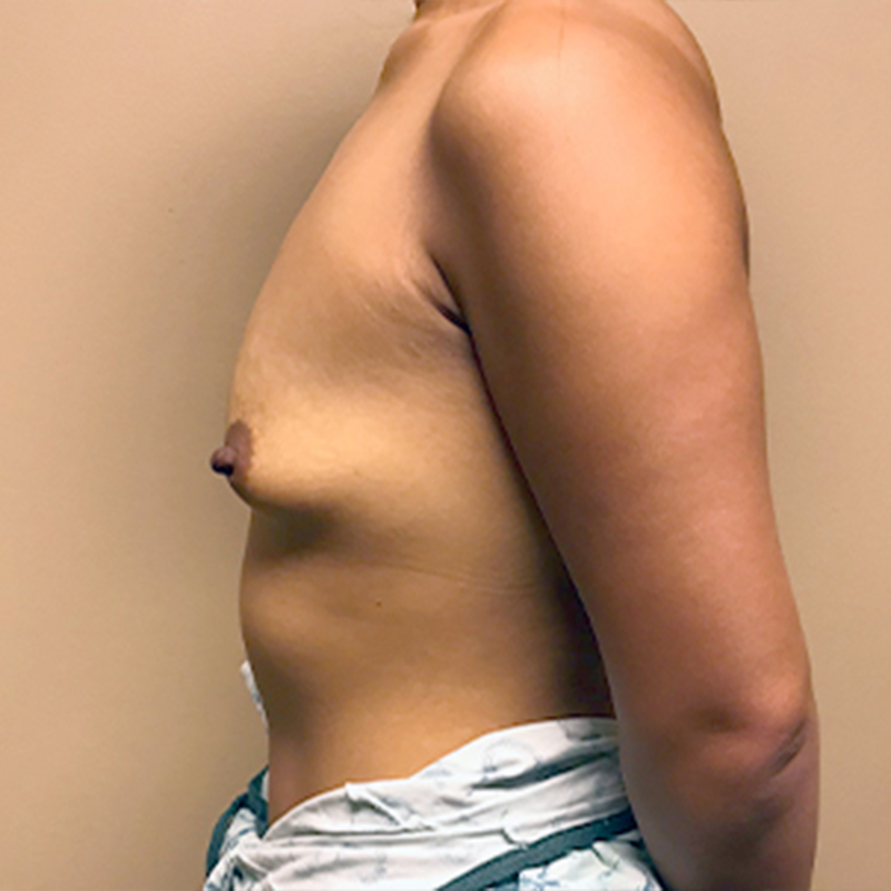 Breast Augmentation 05