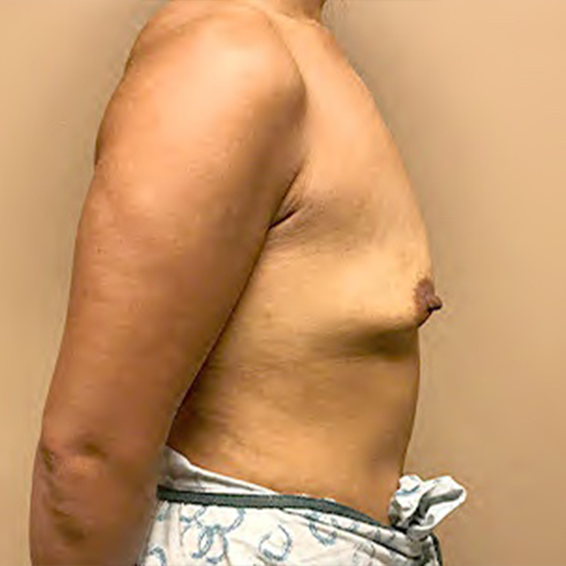 Breast Augmentation 09