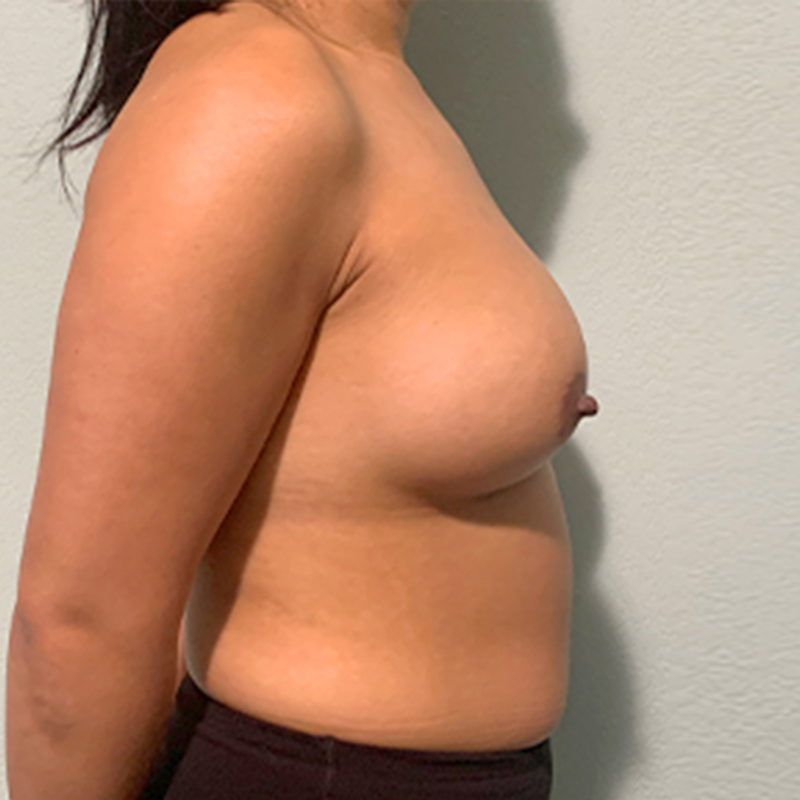 Breast Augmentation 09