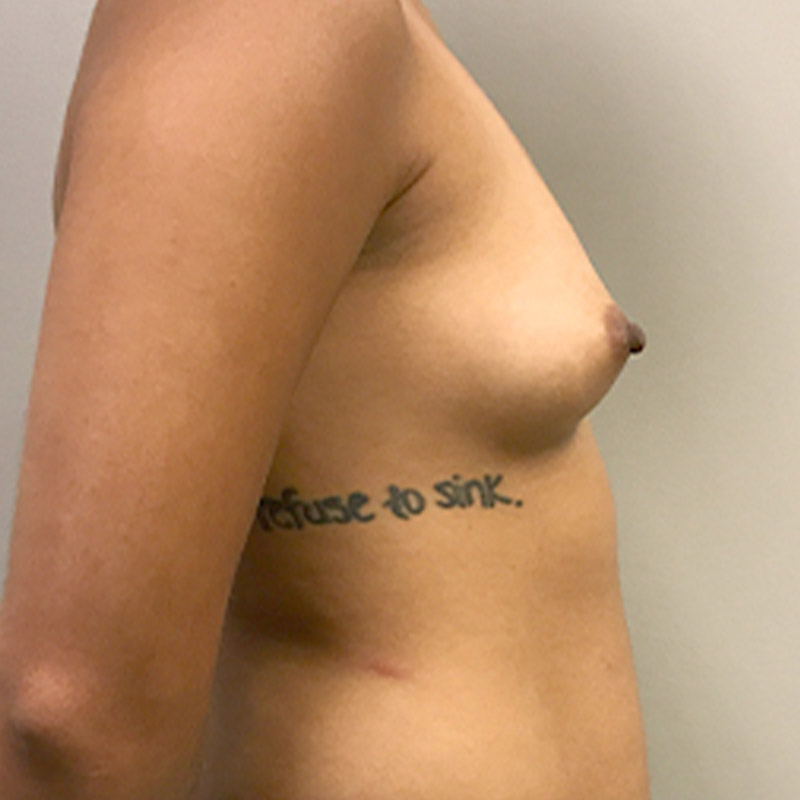 Breast Augmentation 09