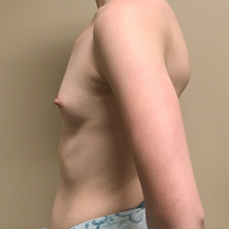 Breast Augmentation 05