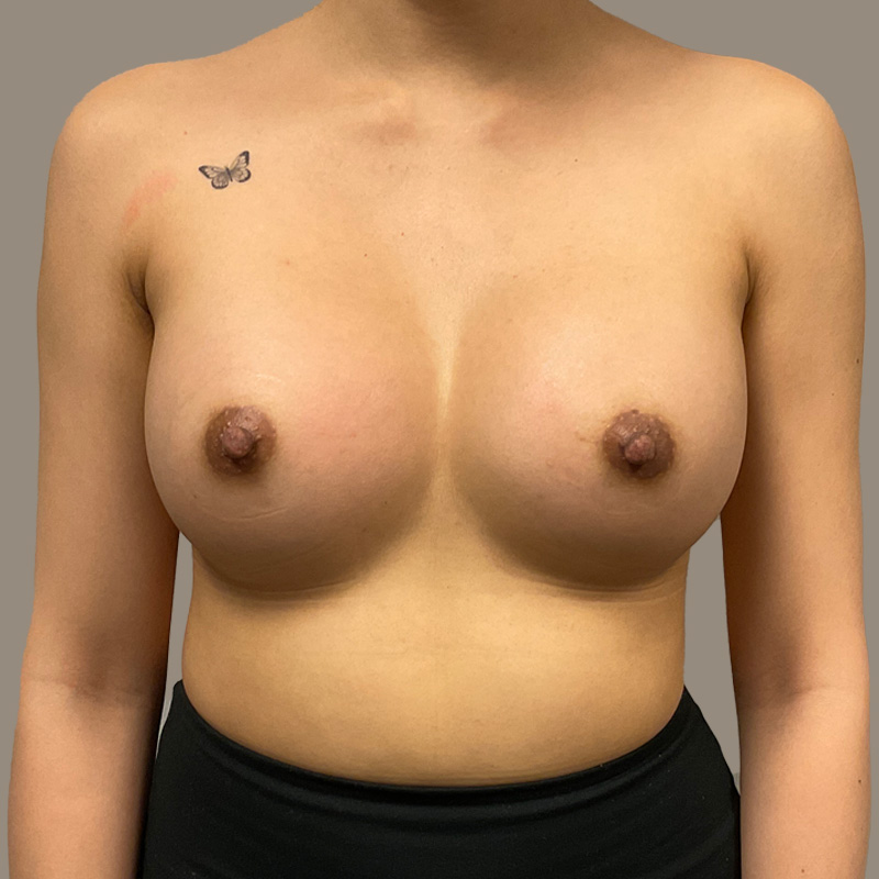 Breast Augmentation 11
