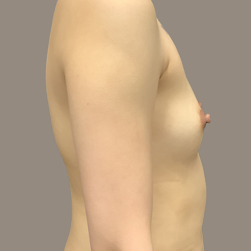 Breast Augmentation 03