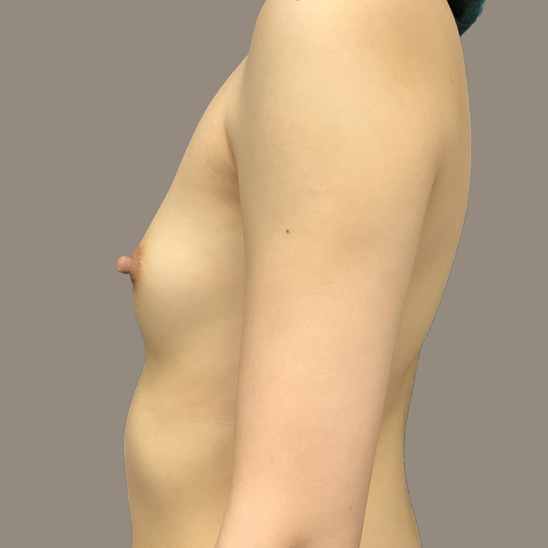 Breast Augmentation 05