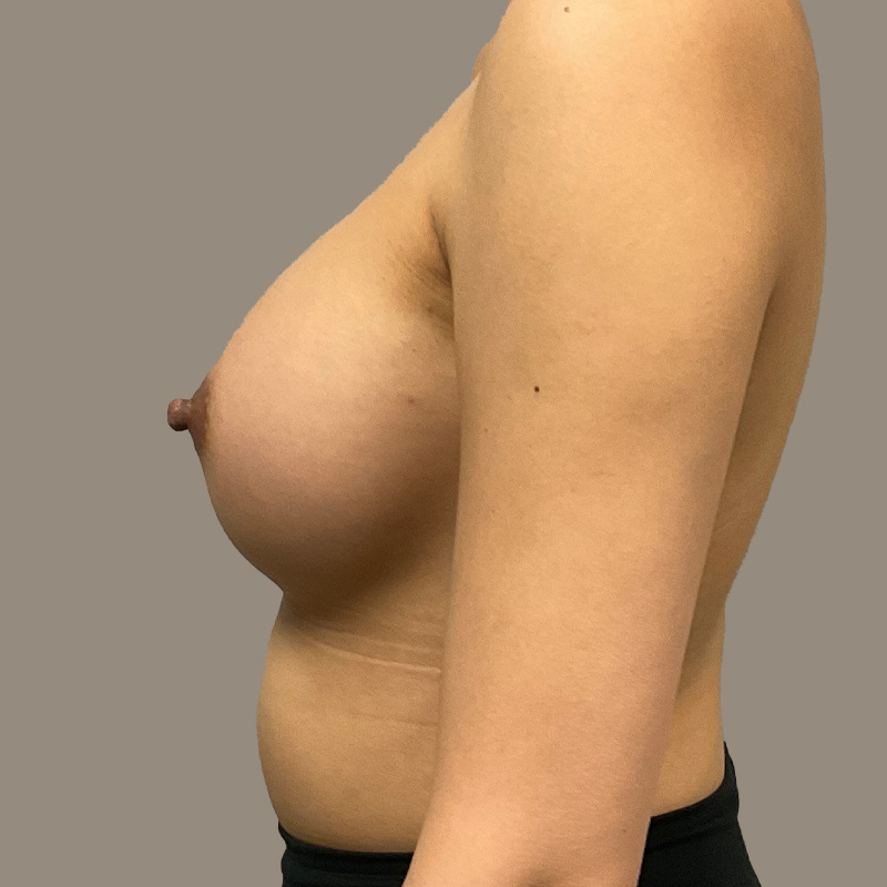 Breast Augmentation 05