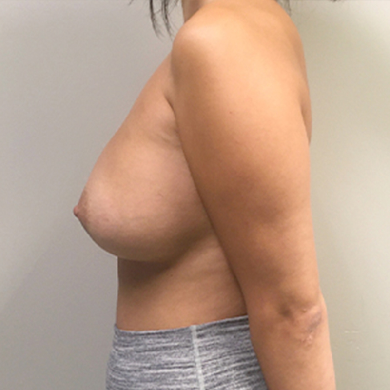 Breast Augmentation 05