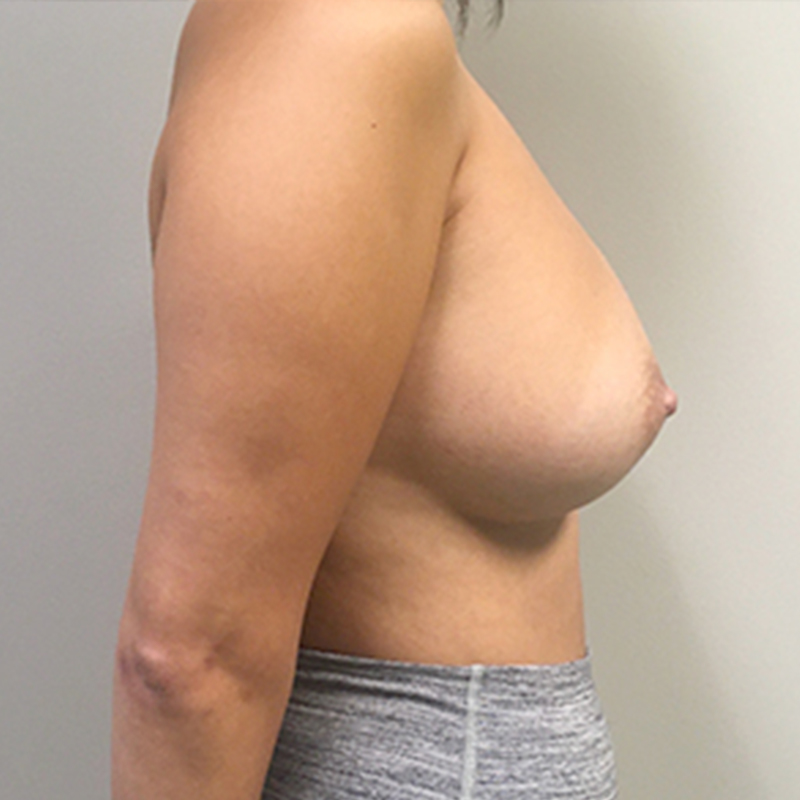 Breast Augmentation 09