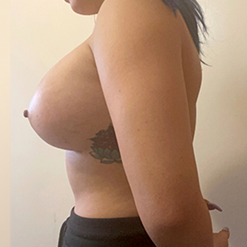 Breast Augmentation 05
