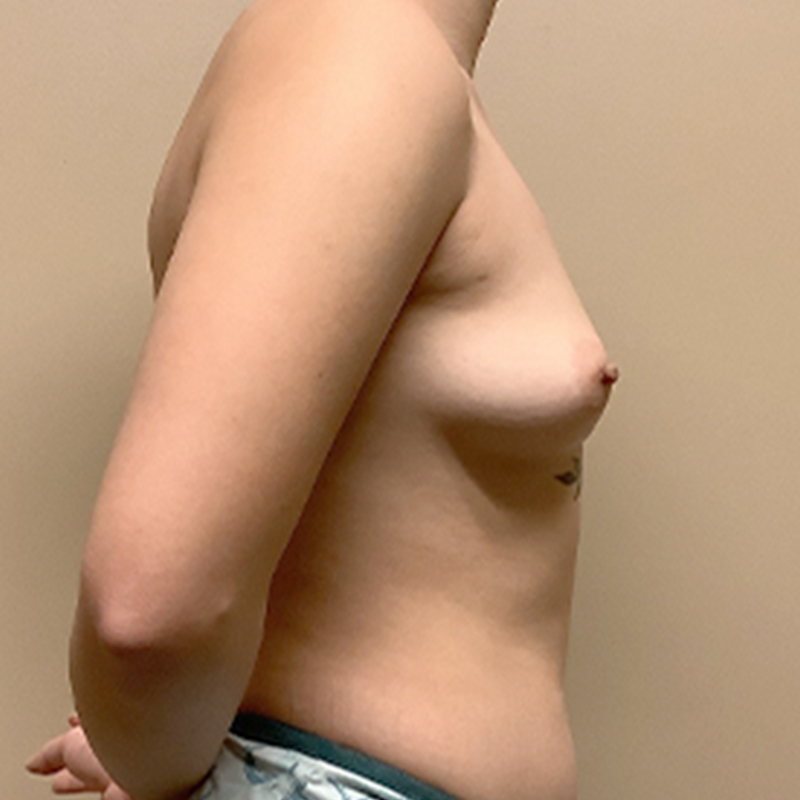 Breast Augmentation 09