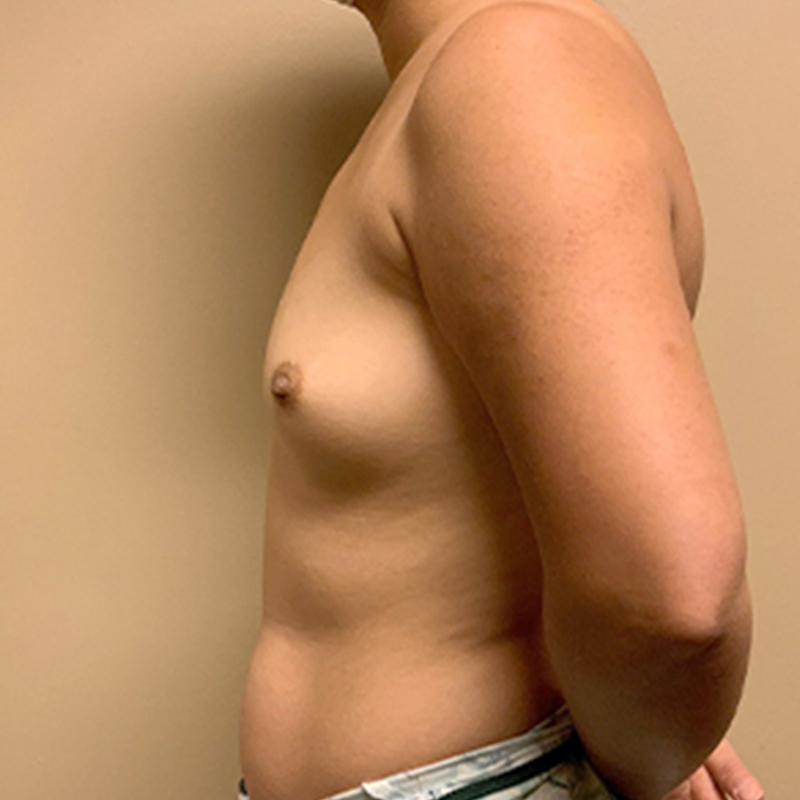 Breast Augmentation 05