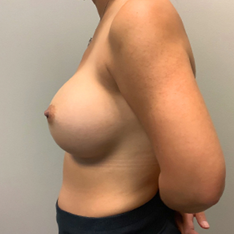 Breast Augmentation 05