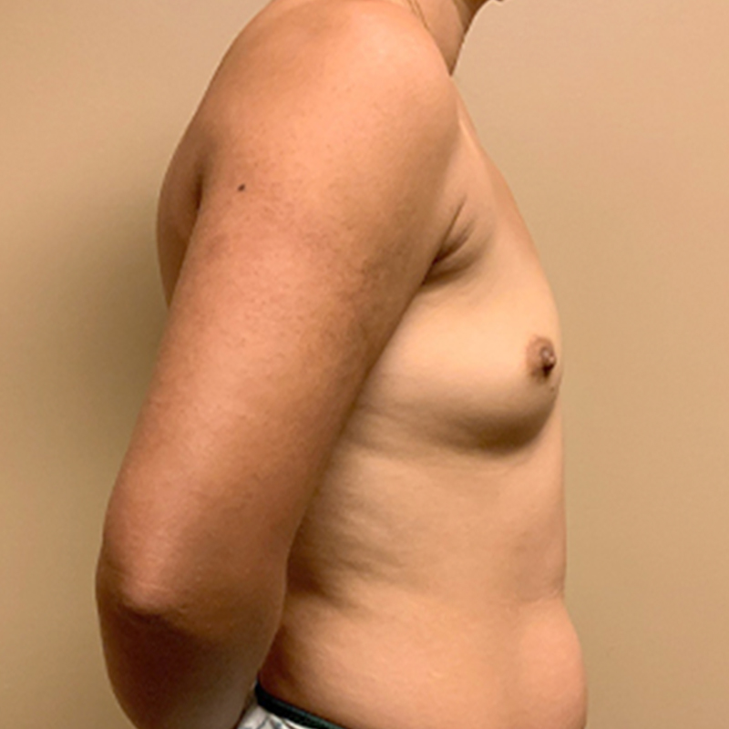 Breast Augmentation 09