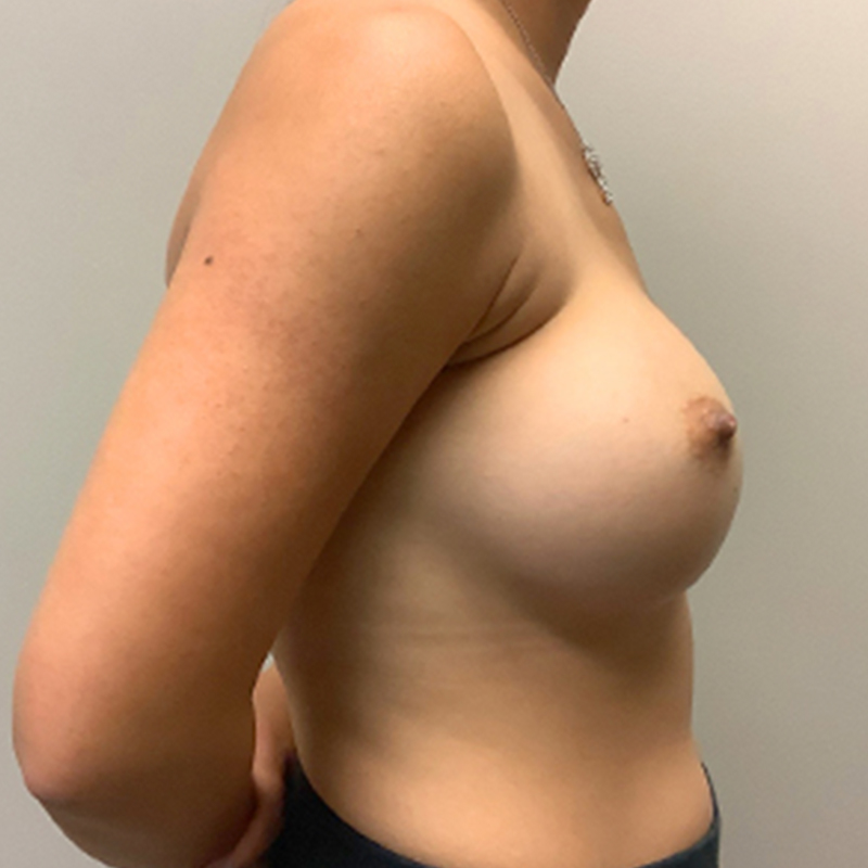Breast Augmentation 09