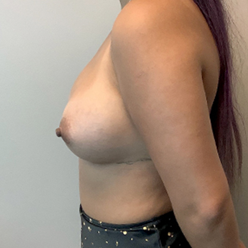Breast Augmentation 05