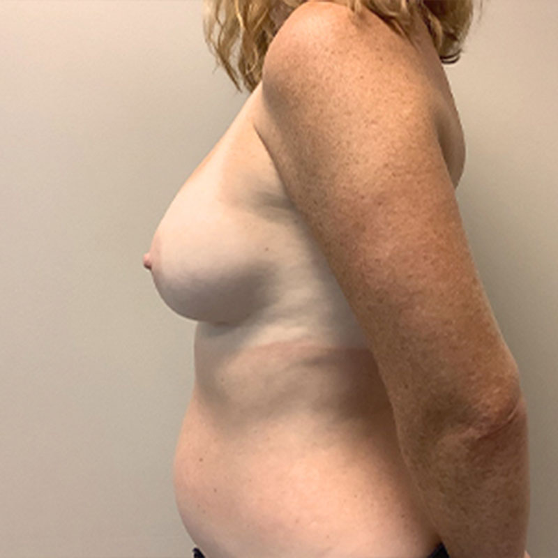 Breast Augmentation 05