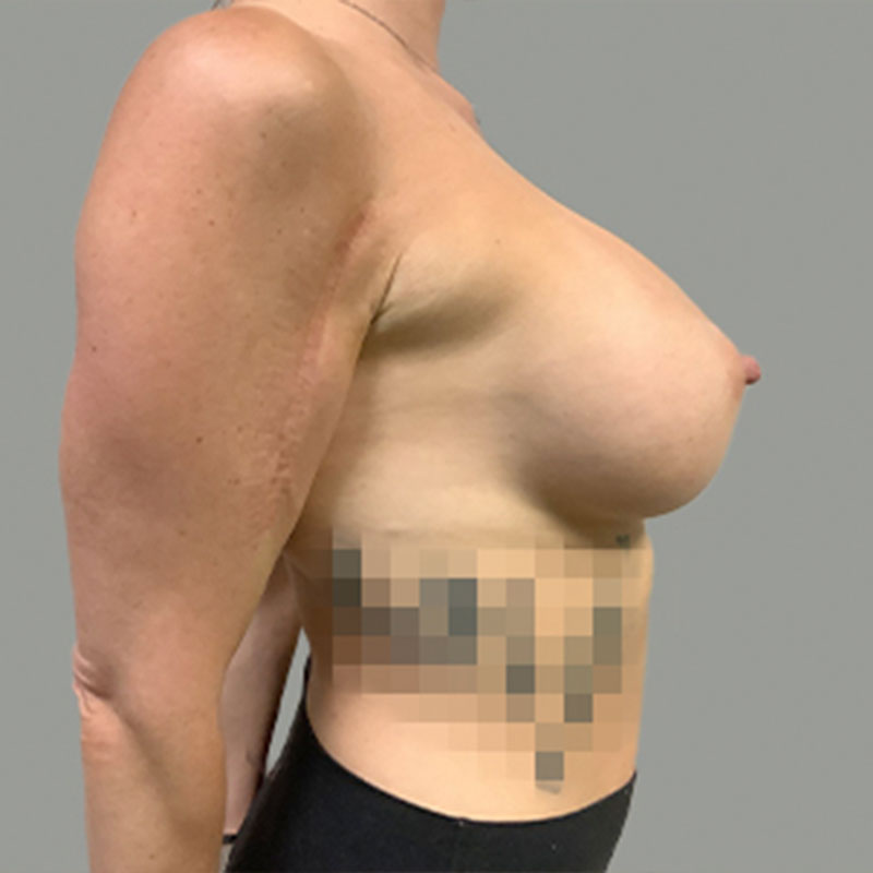 Breast Augmentation 09