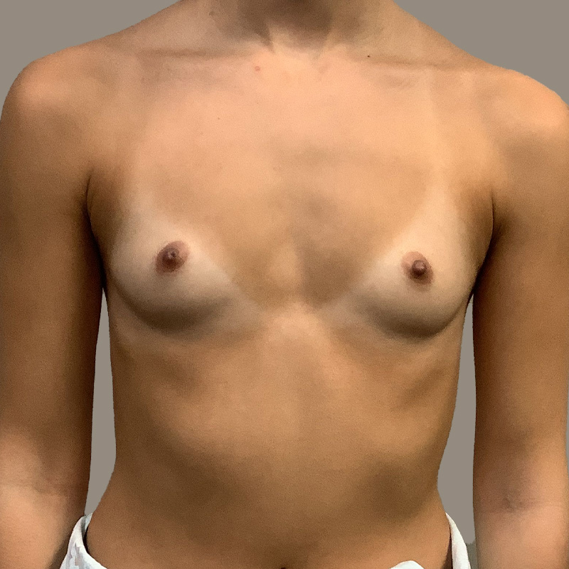 Breast Augmentation 01