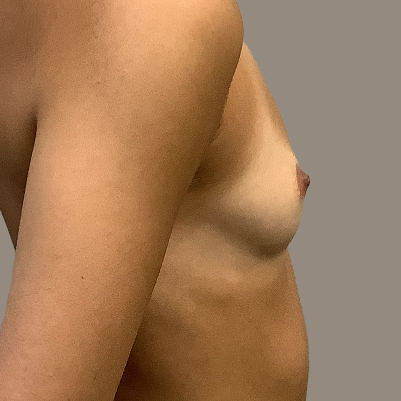 Breast Augmentation 03