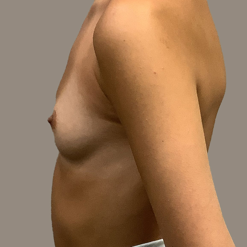 Breast Augmentation 07
