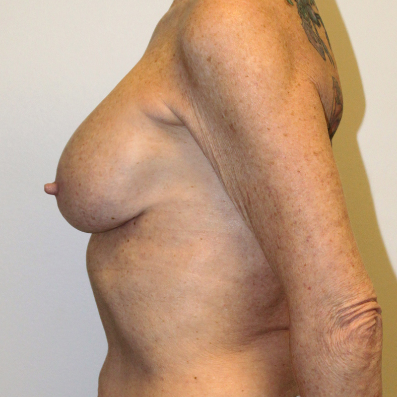 Breast Augmentation 05