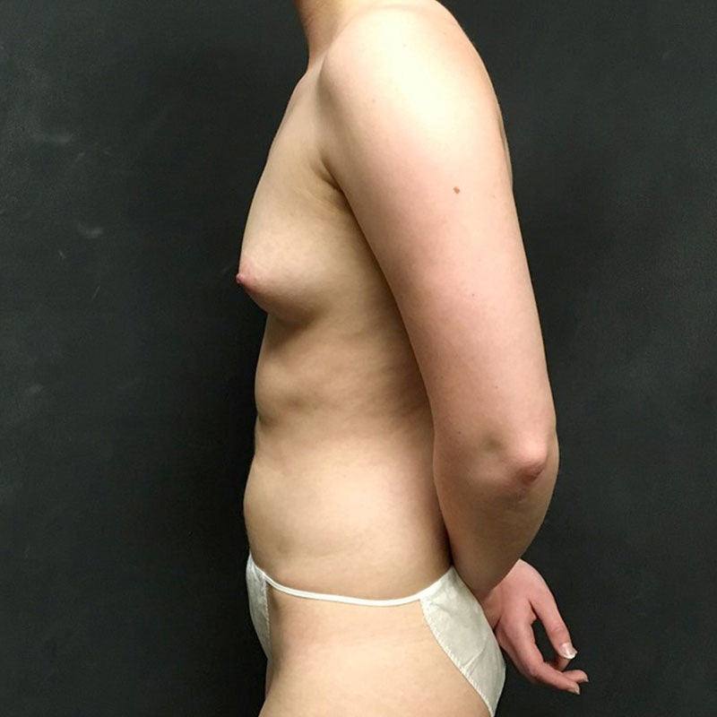 Breast Augmentation 07