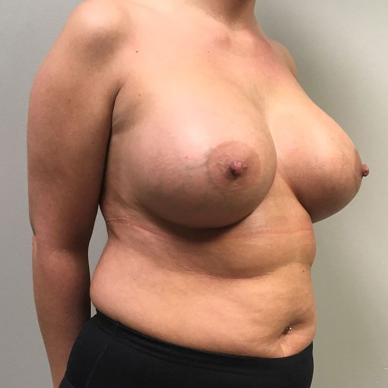 Breast Augmentation 05