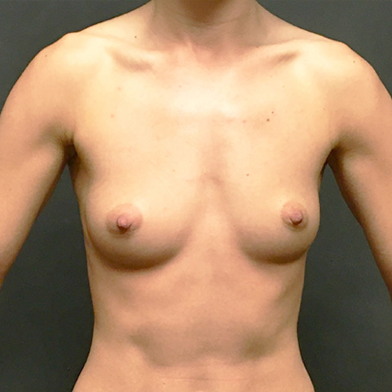 Breast Augmentation 01